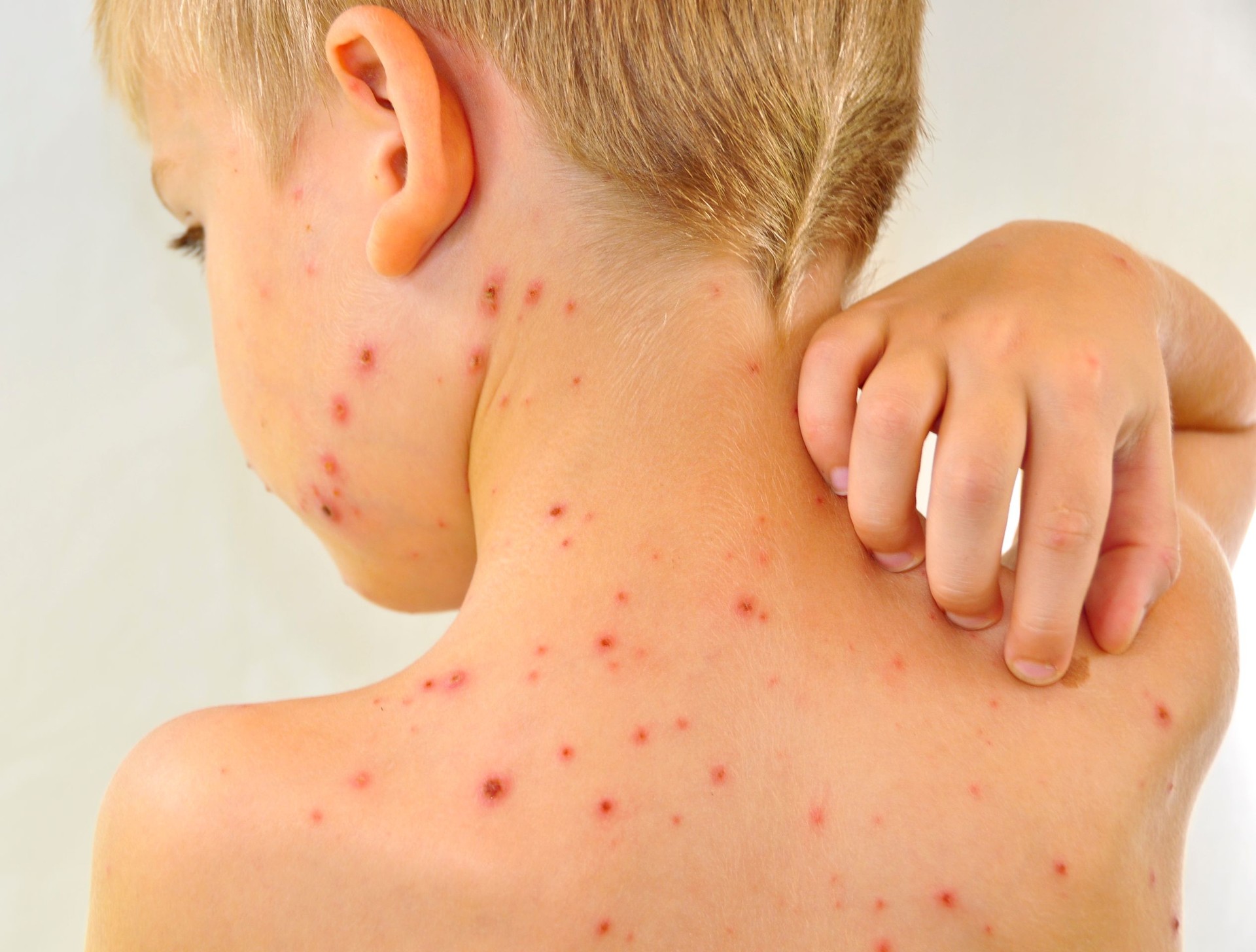 Little boy scratching me his chickenpox Little boy scratching me his chickenpox